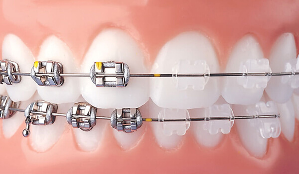 brackets-metalicos-esteticos