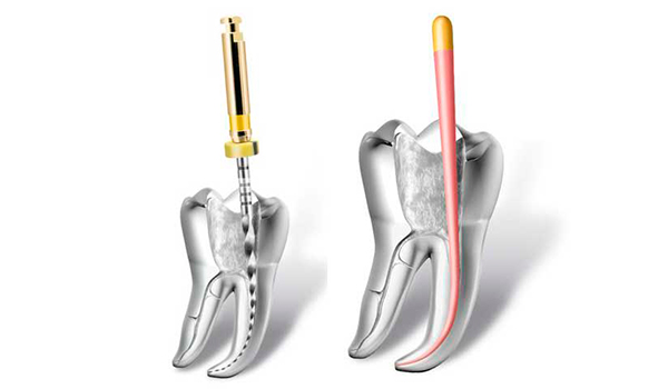 endodoncia-g