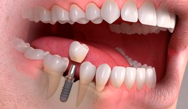 implantologia-clinicadentalgomeza